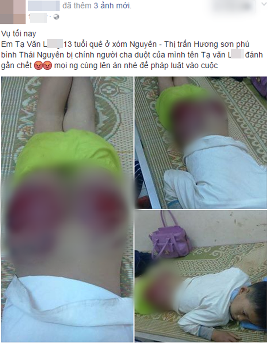 Hình ảnh gây phẫn nộ: Bé trai 13 tuổi bị cha ruột đánh tứa máu - Ảnh 1.