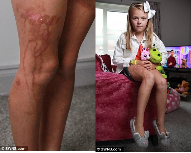 Sử dụng kem chống nắng, cô bé 9 tuổi bị cháy da nghiêm trọng như bị nhỏ axit - Ảnh 3.