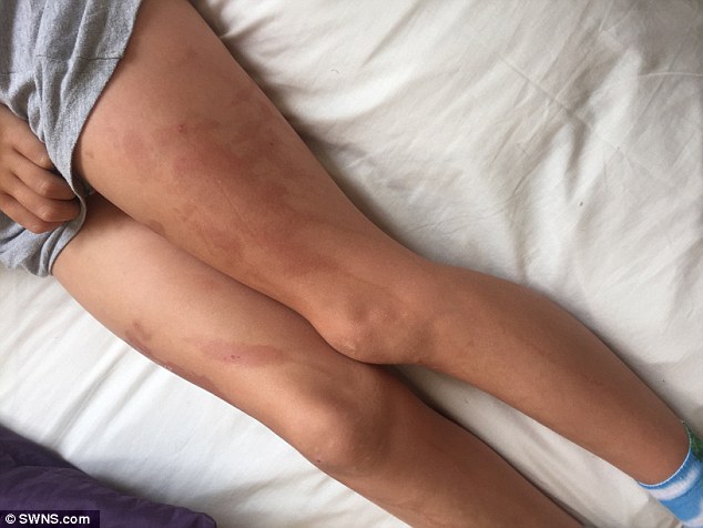 Sử dụng kem chống nắng, cô bé 9 tuổi bị cháy da nghiêm trọng như bị nhỏ axit - Ảnh 2.