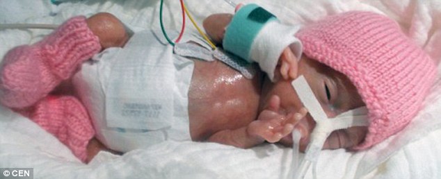 Kỳ tích sống sót của bé sơ sinh nhỏ nhất thế giới, nặng 220g với kích thước chỉ bằng 2 bàn tay - Ảnh 2.