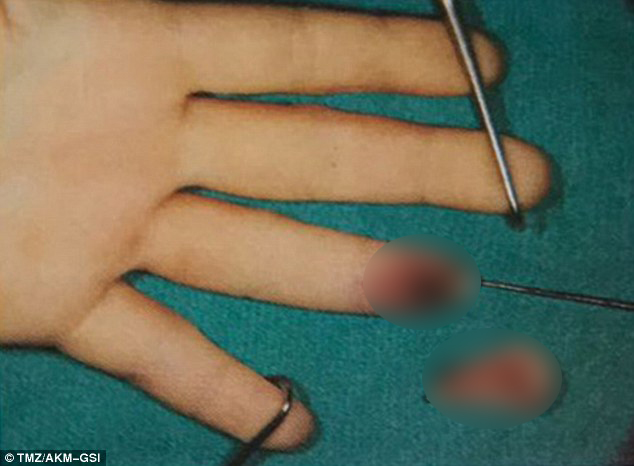 Lộ thêm ảnh về đầu ngón tay bị đứt lìa của Lindsay Lohan - Ảnh 1.