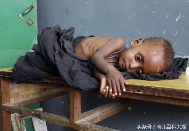 Chùm ảnh những đứa trẻ châu Phi gầy trơ xương vì đói sẽ khiến bạn không dám bỏ thừa đồ ăn thêm nữa - Ảnh 1.