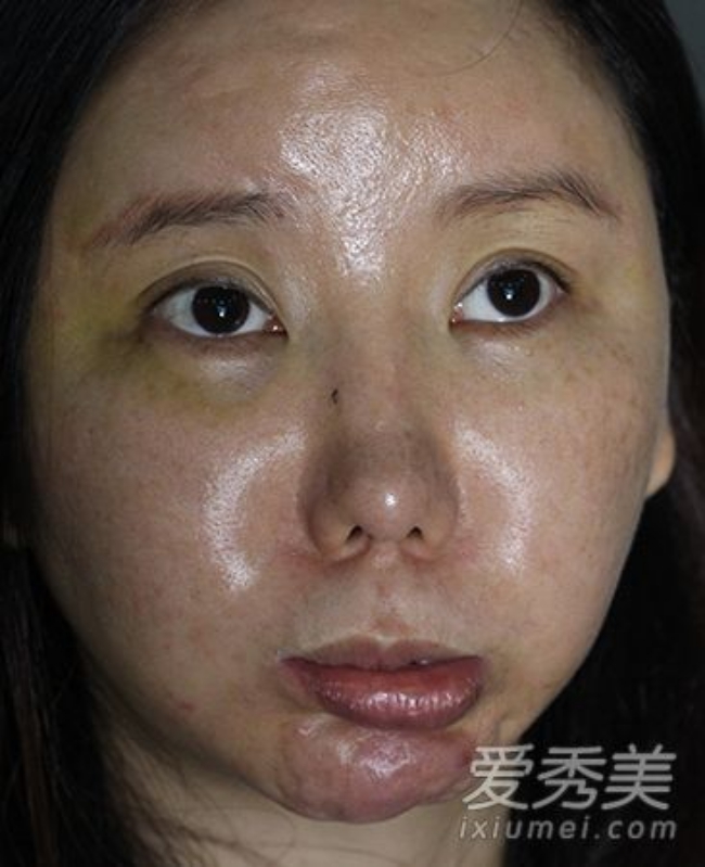 Ham đẹp như gái Hàn, nhiều phụ nữ Trung Quốc ôm hận thiên thu vì phẫu thuật thẩm mỹ hỏng - Ảnh 6.