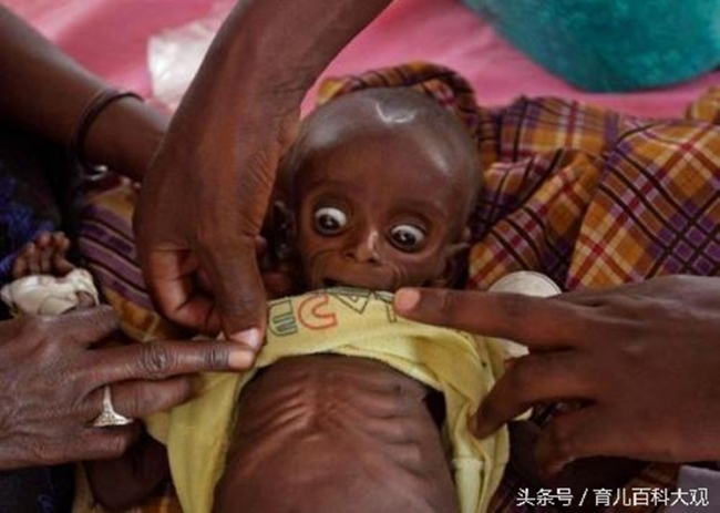 Chùm ảnh những đứa trẻ châu Phi gầy trơ xương vì đói sẽ khiến bạn không dám bỏ thừa đồ ăn thêm nữa - Ảnh 3.