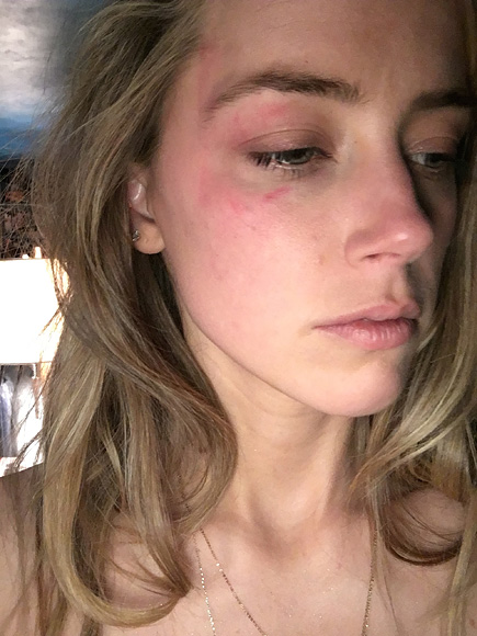 Amber Heard tung th&ecirc;m ảnh mặt bầm t&iacute;m, tin nhắn tố Johnny Depp bạo h&agrave;nh - Ảnh 5.