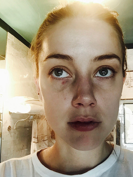 Amber Heard tung th&ecirc;m ảnh mặt bầm t&iacute;m, tin nhắn tố Johnny Depp bạo h&agrave;nh - Ảnh 2.