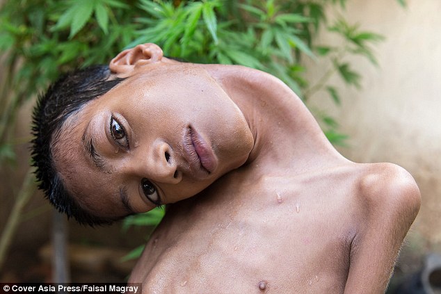 Cậu bé đầu lộn ngược 180 độ đột ngột qua đời sau 8 tháng phẫu thuật - Ảnh 1.