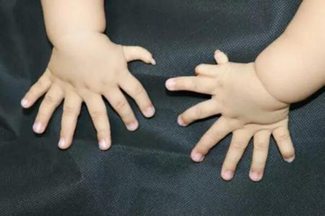 Baby boy born with deformed 31 fingers on both hands and feet - Photo 1.