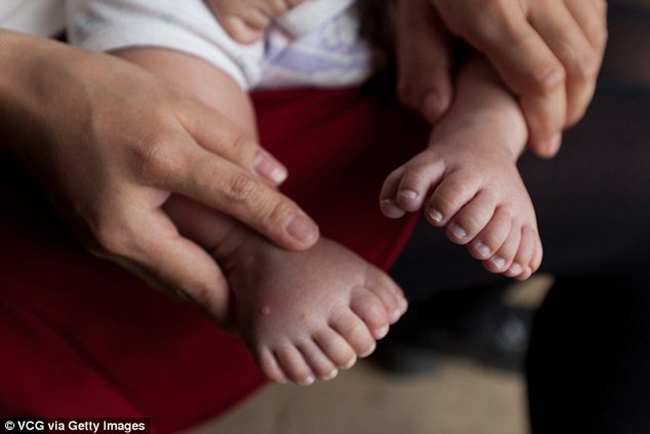 Baby boy born with deformed 31 fingers on both hands and feet - Photo 3.