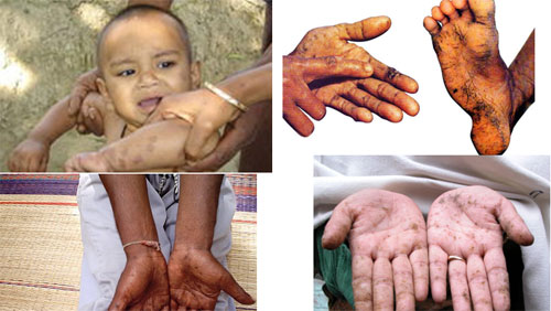 GS Nguyễn Thị Dụ: Nhiễm ch&igrave; nhẹ cũng rất nguy hiểm với trẻ em - Ảnh 1.