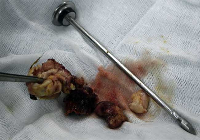 Phẫu thuật khối u dị dạng trong ngực thiếu nữ  - Ảnh 1.
