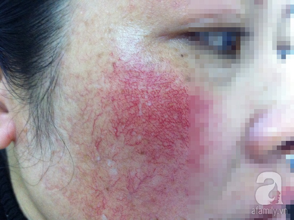 Khóc cạn lời vì da mặt đỏ rát, đầy mụn sau khi sử dụng mỹ phẩm trôi nổi không rõ nguồn gốc - Ảnh 2.