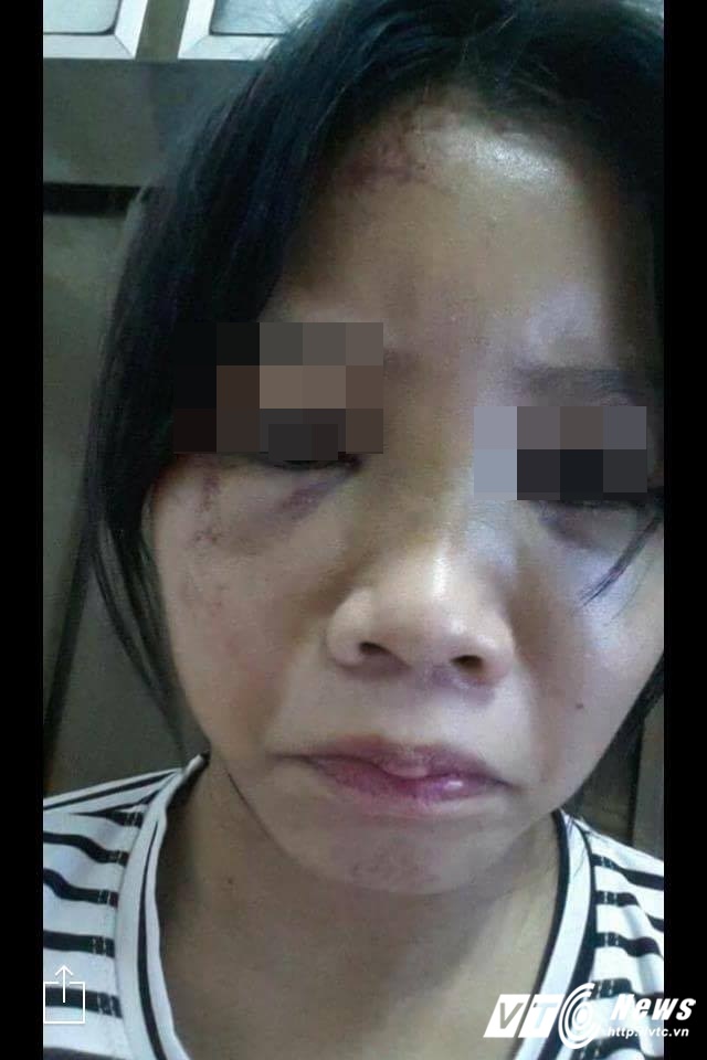 Nữ sinh run sợ kể ph&uacute;t bị bạn ch&acirc;m thuốc l&aacute; v&agrave;o tay, bắt liếm ch&acirc;n - Ảnh 2.