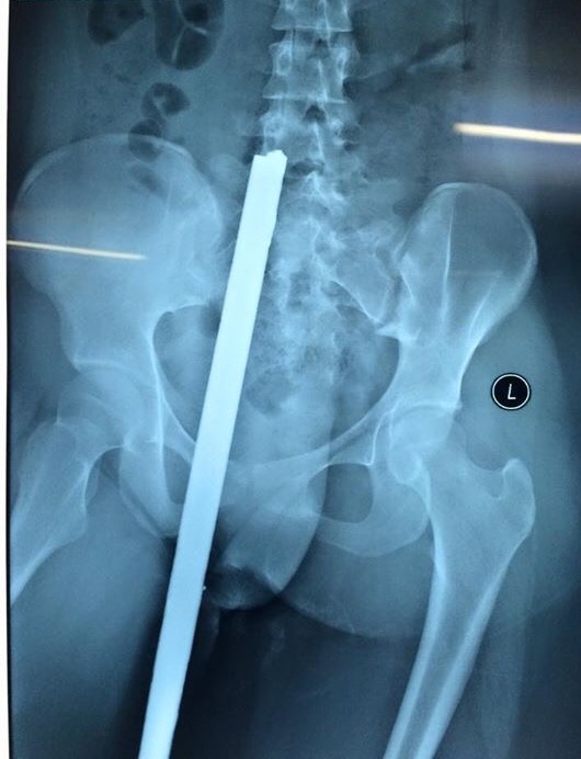 Nữ sinh 16 tuổi bị thanh sắt đâm xuyên người - Ảnh 1.