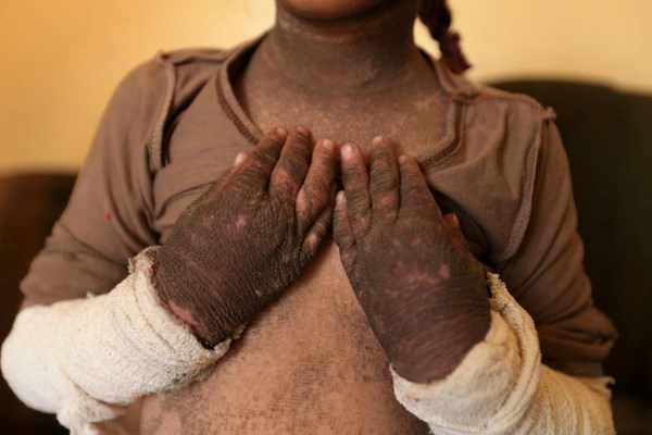 Bàng hoàng với làn da của cô bé 5 tuổi sau vụ tấn công hóa học của IS - Ảnh 1.