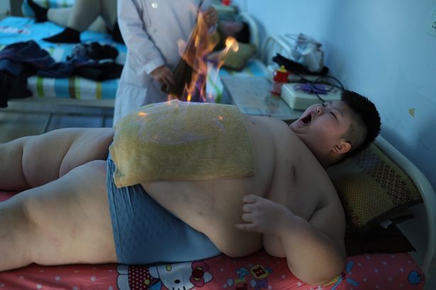 Dùng lửa đốt mỡ bụng, phương pháp giảm cân cho nhiều trẻ em béo phì tại Trung Quốc - Ảnh 4.