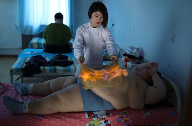 Dùng lửa đốt mỡ bụng, phương pháp giảm cân cho nhiều trẻ em béo phì tại Trung Quốc - Ảnh 1.