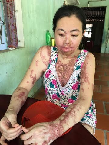 Uẩn ức người đàn bà bị tạt axit giữa Sài Gòn - Ảnh 1.