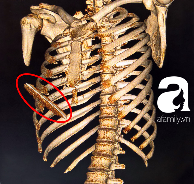 Thanh ni&ecirc;n bị lưỡi dao 10 cm đ&acirc;m l&uacute;t ngực, thủng gan vẫn may mắn tho&aacute;t chết - Ảnh 1.