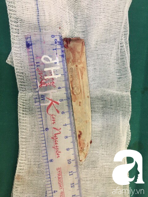 Thanh ni&ecirc;n bị lưỡi dao 10 cm đ&acirc;m l&uacute;t ngực, thủng gan vẫn may mắn tho&aacute;t chết - Ảnh 2.