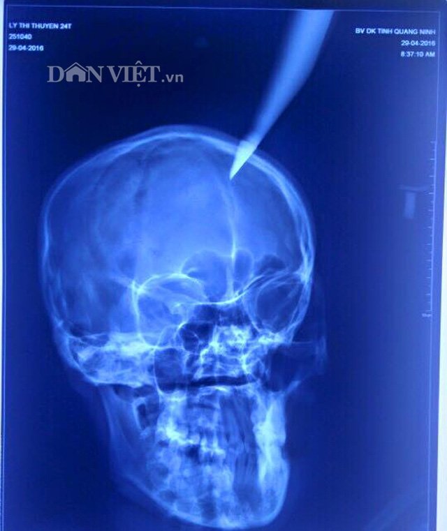 Quảng Ninh: Thai phụ bị dao nhọn đâm vào não sâu 4cm - Ảnh 2.