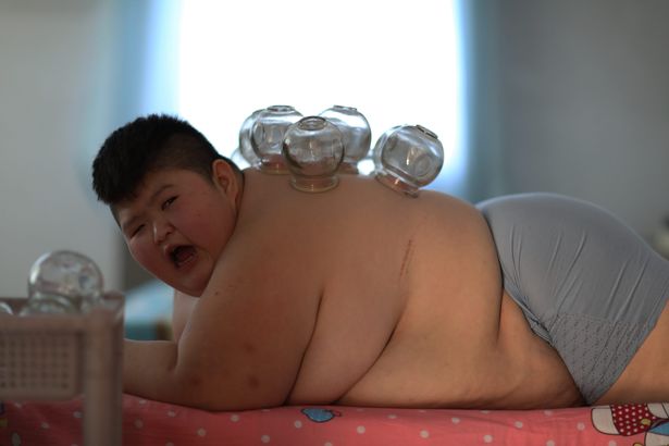 Dùng lửa đốt mỡ bụng, phương pháp giảm cân cho nhiều trẻ em béo phì tại Trung Quốc - Ảnh 2.