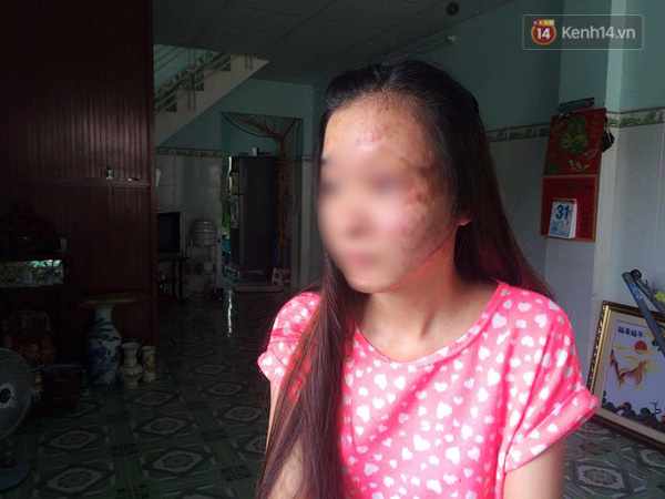 6 tháng sau khi vụ tạt axit hủy hoại khuôn mặt, nữ sinh Sài Gòn chỉ biết giam mình trong bóng tối - Ảnh 3.