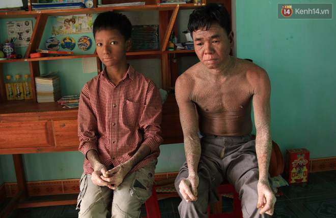 Cậu bé người rắn ở Quảng Nam: Hồi trước các bạn bỏ chạy vì sợ, nhưng giờ nhiều bạn thân với con lắm - Ảnh 1.