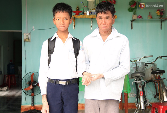 Cậu bé người rắn ở Quảng Nam: Hồi trước các bạn bỏ chạy vì sợ, nhưng giờ nhiều bạn thân với con lắm - Ảnh 11.