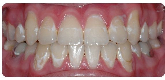 Răng bạn có những đốm trắng này không - hãy cẩn thận nếu thấy chúng - Ảnh 4.