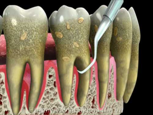 Vì sao răng của chúng ta lại xuất hiện những mảng bám kinh dị - Ảnh 4.