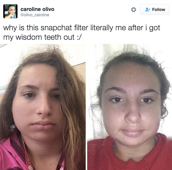Nở rộ trào lưu khoe ảnh nhổ răng khôn chẳng cần tới hiệu ứng như Snapchat - Ảnh 9.