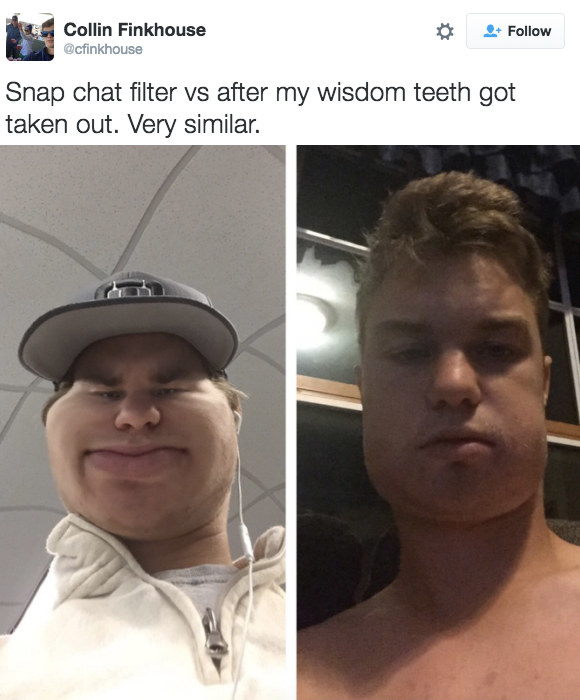 Nở rộ trào lưu khoe ảnh nhổ răng khôn chẳng cần tới hiệu ứng như Snapchat - Ảnh 2.