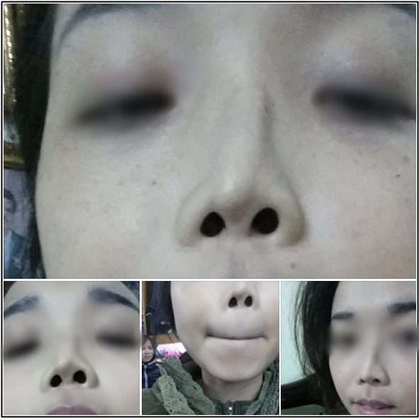 Cô gái Hà Nội bế tắc vì đã 2 lần đau đớn PTTM nhưng mũi vẫn... lệch - Ảnh 2.