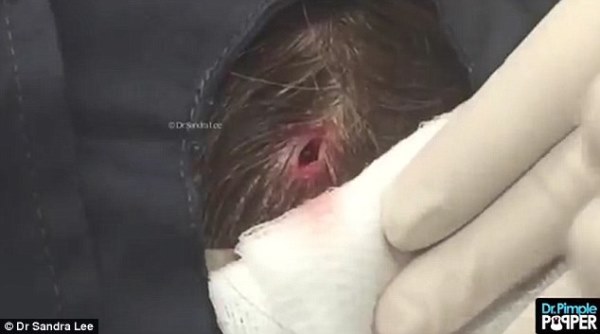 Rùng mình với pha nặn u nang to như 3 quả tên lửa trên đầu - Ảnh 3.