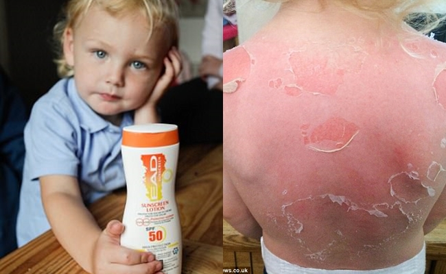 Dùng kem chống nắng SPF 50 đi dã ngoại, bé trai 3 tuổi bị cháy nắng và phồng rộp nghiêm trọng - Ảnh 1.