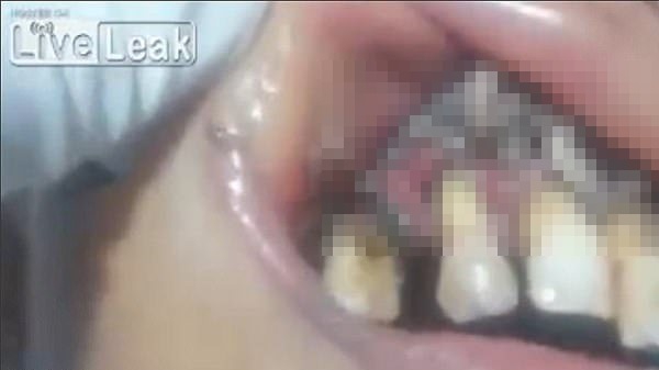 Soi kỹ vật thể lạ trong miệng người phụ nữ, ai cũng khiếp sợ và đi kiểm tra răng miệng ngay - Ảnh 2.