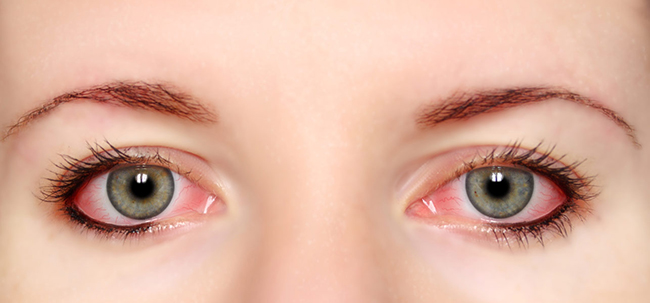 Đừng để những thói quen không tốt là tác nhân gây bệnh đau mắt đỏ trong hè này - Ảnh 1.