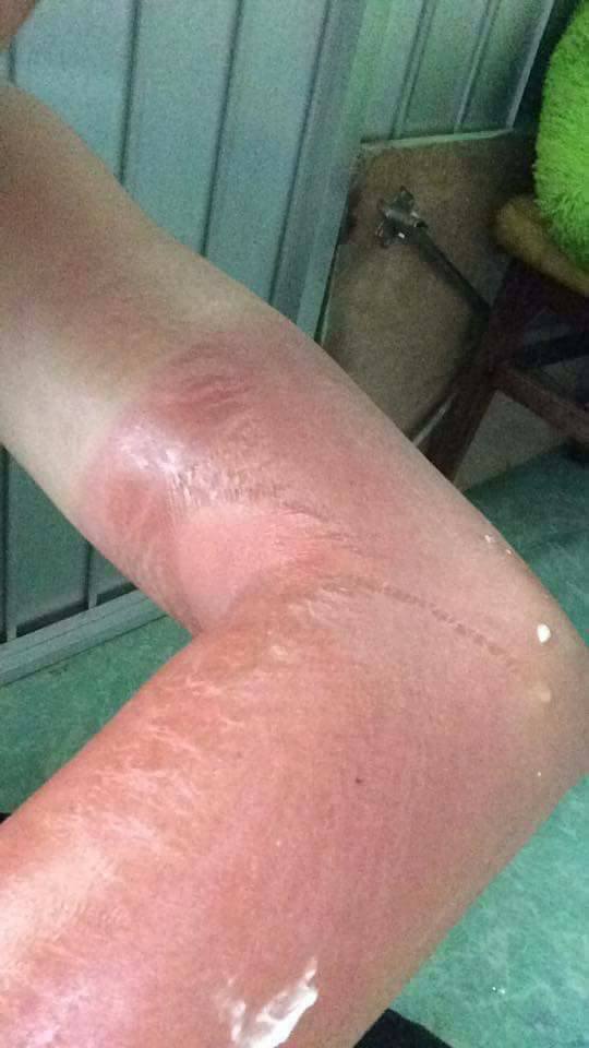 Đ&acirc;y l&agrave; kết quả của nam thanh ni&ecirc;n chủ quan với trời nắng - Ảnh 1.