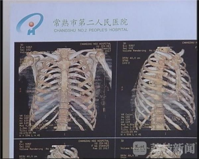 B&agrave; mẹ U70 bị con trai ruột đ&aacute;nh g&atilde;y 11 chiếc xương sườn, thủng m&agrave;ng nhĩ tai tr&aacute;i - Ảnh 2.