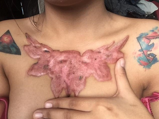 Xóa hình xăm hoa hồng khủng trên ngực, nữ sinh viên Thái Lan phải nhận cái kết đau đớn - Ảnh 5.