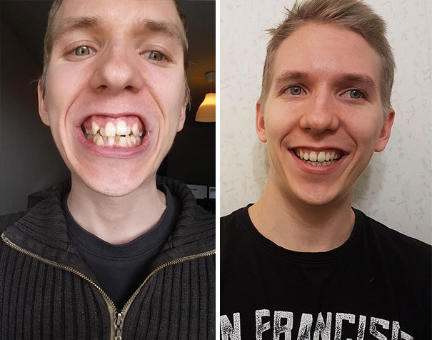 19 khuôn mặt thay đổi ngoạn mục chứng tỏ sức mạnh của niềng răng thật là vi diệu - Ảnh 21.