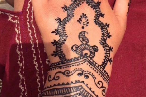 Cô gái bị phồng rộp tay nặng nề do dị ứng mực xăm henna - Ảnh 2.