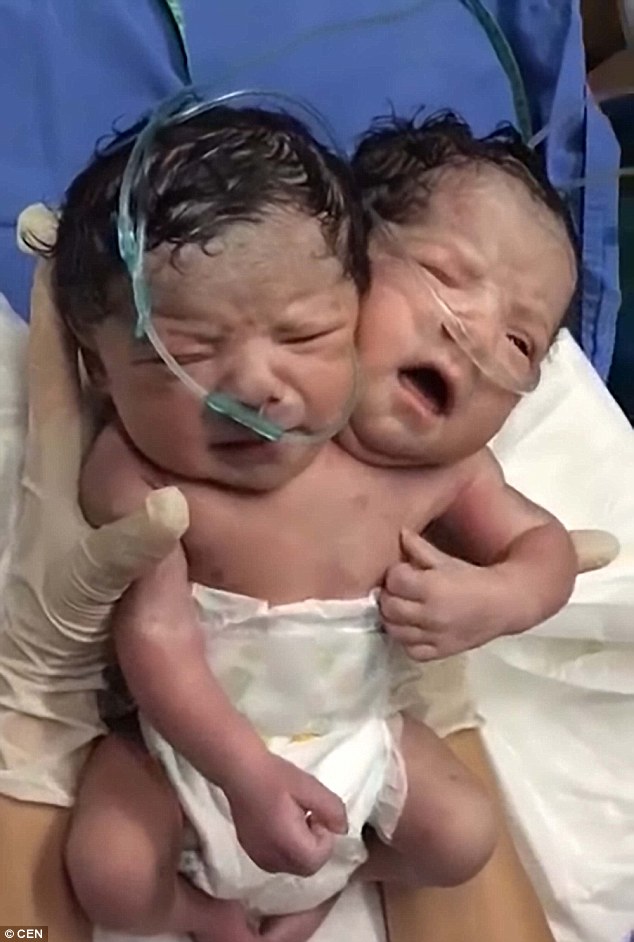 Video: Cặp song sinh liền thân khóc òa sau khi lọt lòng mẹ - Ảnh 2.