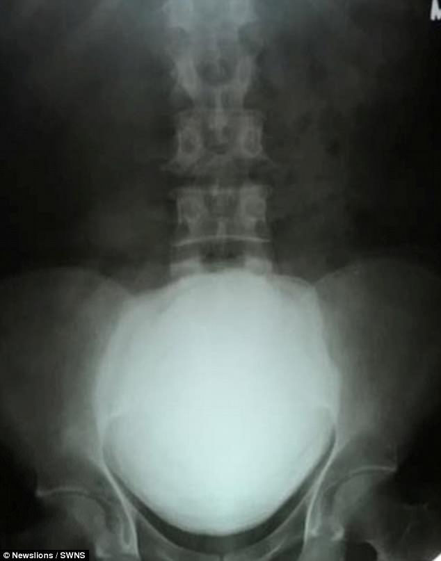 T&igrave;m thấy vi&ecirc;n sỏi to 17cm trong b&agrave;ng quang người đ&agrave;n &ocirc;ng Ấn Độ - Ảnh 3.