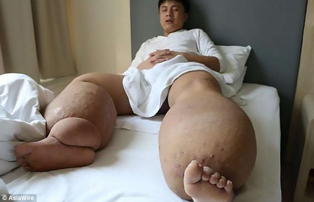 Người đàn ông có đôi chân nặng 150kg chỉ vì một vết muỗi đốt - Ảnh 1.