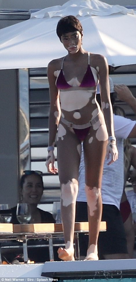 Người mẫu bạch biến mặc bikini khoe làn da loang lổ độc đáo, làm lu mờ cả Bella Hadid - Ảnh 1.
