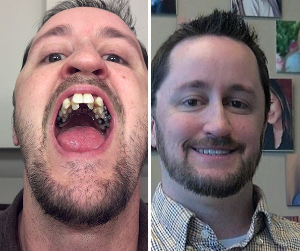 19 khuôn mặt thay đổi ngoạn mục chứng tỏ sức mạnh của niềng răng thật là vi diệu - Ảnh 35.