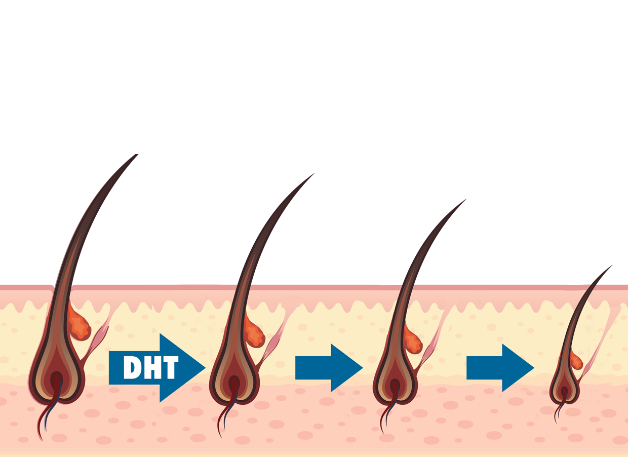 Loại hormone được tình nghi là thủ phạm gây nên chứng hói đầu ở nam giới là gì? - Ảnh 1.