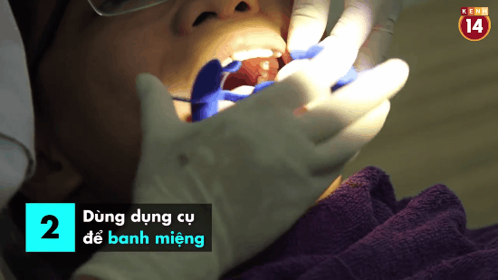 Cận cảnh một ca tẩy trắng răng tại phòng khám và kết quả ngay sau khi hoàn thành - Ảnh 3.